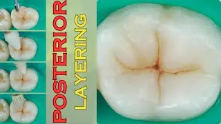 1-minute posterior composite layering