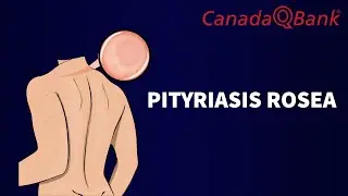 Pityriasis Rosea Explained | Herald Patch, Rash & Treatment | Dermatology | CanadaQBank