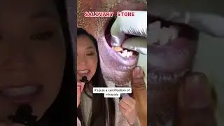Biggest salivary stone I’ve ever seen! 
