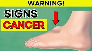 See a Doctor IMMEDIATELY if You have These Signs of Cancer | Daily Joy