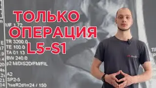 Лечение  грыжи L5-S1 БЕЗ ОПЕРАЦИИ . Отзыв о лечении триггеров и фиброза в miofix методом миопрессуры