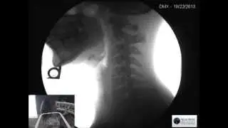 Digital Motion X-Ray (DMX) New at the NeuroSpine Institute (Live X-Ray)