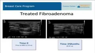 Carrie Rochman - Treatment of breast fibroadenoma with high intensity FUS: Feasibility study (2016)