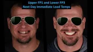 Complex Case Presentation:  Immediate Load Upper FP1 and Lower FP3