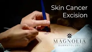 Skin Cancer Excision procedure with Dr. Carla Gustovich at Magnolia Dermatology of Frisco