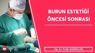 BURUN ESTETİĞİ ÖNCESİ VE SONRASI
