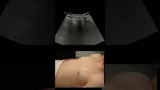 Lateral Chest #POCUS