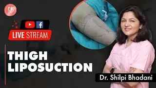 Live session with Dr. Shilpi Bhadani about Thigh Liposuction | SB Aesthetics