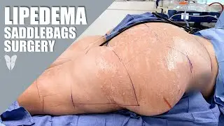 Lipedema Reduction Surgery: Thighs & Buttocks | Total Lipedema Care
