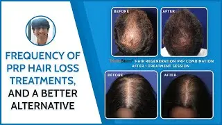 How Many PRP Hair Injections are Needed to See Results?