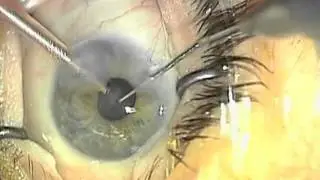 Cataract Surgery: Unstretched Small Pupil by Dr. Shawn Cohen