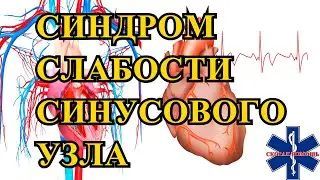 Синдром слабости синусового узла
