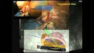 Real time TRUS-guided free-hands technique for focal cryoablation of the prostate: Step-by-Step