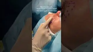 Блефаропластика нижних век