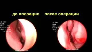 Удаление гребня перегородки носа (Лазерная кристотомия)  27012018 с2