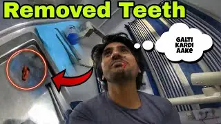 अकल दार्द वाले  दांत को निकलवा दिआ || REMOVED TEETH || 🥲🦷🦷