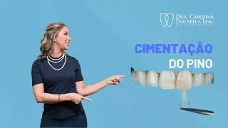 Cimentação de pino de fibra de vidro