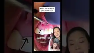 What happens when the nerve inside a tooth dies? 