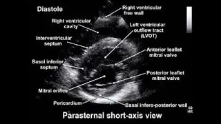Echocardiography Lecture 3 PSAX ( Parasternal Short Axis )