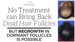 Why No Treatment can Revive Dead Hair Follicles, but Regrowth of Dormant Follicles is Possible
