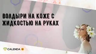 Волдыри на коже с жидкостью на руках