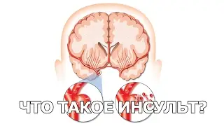 Инсульт: что это?