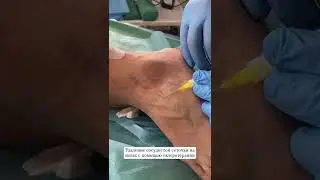 Удаление сосудистого рисунка на ногах. 