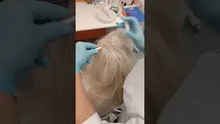 Мезотерапия кожи головы