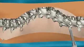 Fact | Spinner surgery 😳 #khansir  #escoliose #facts #useful