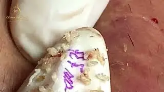 Grossly Satisfying Pimple Popping Compilation