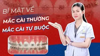 4 Bí Mật Mà Mọi Người Phải Biết Về Mắc Cài Thường Và Mắc Cài Tự Buộc | Bác sĩ Trung Long Biên