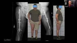 Management of Bone Defects with Dr. Austin Fragomen, MD - Part 3