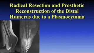 Radical Resection and Prosthetic Reconstruction of the Distal Humerus due to a Plasmocytoma