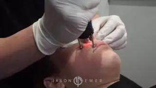 Erbium Laser Resurfacing / Treatment of Melasma / Sun Spots and Pigmentation / Beverly Hills, CA