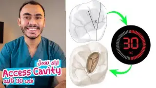 Endodontic Access Cavity Preparation