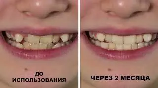 Капа для выравнивания зубов. Dent oral pro