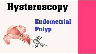 Hysteroscopy - Endometrial Polyp