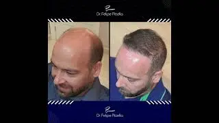 GREAT HAIR TRANSPLANT RESULT BY NORWOOD 7 - Dr. Pittella
