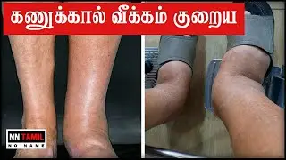 கால் மற்றும் கணுக்கால் வீக்கம் | Leg Swelling Remedies | Leg Pain Kaal Vali | NN Tamil