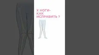 Х ноги, как исправить ?