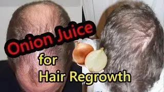 Onion Juice for Hair Regrowth & Stop Hair Loss (Before and After & How to Treat Fast)