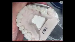 How to do Contacts and Margins on Upper #3 to #14 Facial Cutback Zirconia Singles