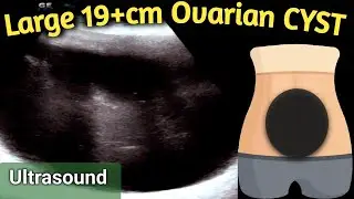 Ultrasound 19+ cm Large Ovarian Cyst | equal to size of Handball in Abdomen