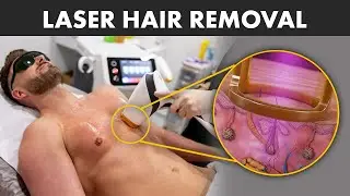 How Laser Hair Removal works? Is it Safe?