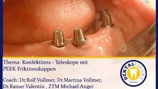 Zahntechnik -  FREE VIDEO - Konfektions-Teleskope mit PEEK Friktionskappen