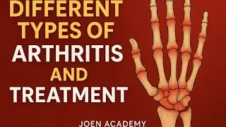 Arthritis Management in Older People | Joen Academy