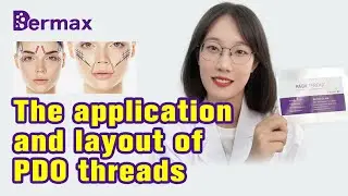 The application and layout of PDO threads|PDO Thread|Thread Lift|PDO Thread Lift|Med Spa