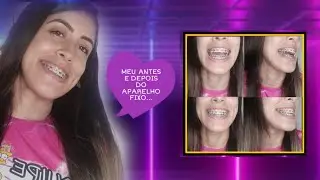 AS LIGAS ORTODÔNTICA DOE MUITO?? - (APARELHO FIXO+ LIGAS) #diariodoaparelho