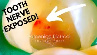 Tooth Cavity - Partial Pulpotomy #2 (Healed Without a Root Canal!) - Dr. Ricucci