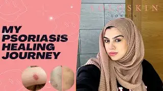 Psoriasis Journey-Living with Psoriasis-Autoimmune disease